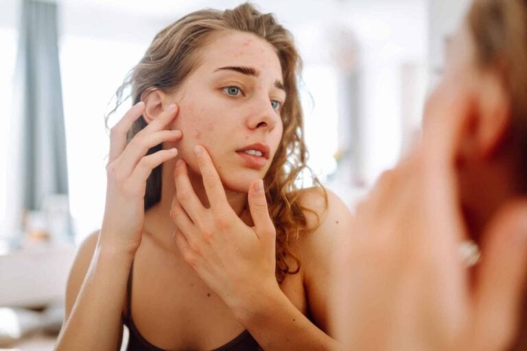 Adult & Hormonal Acne