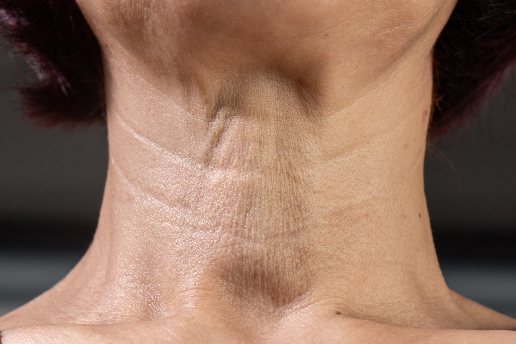 Horizontal creasing across the front of the neck