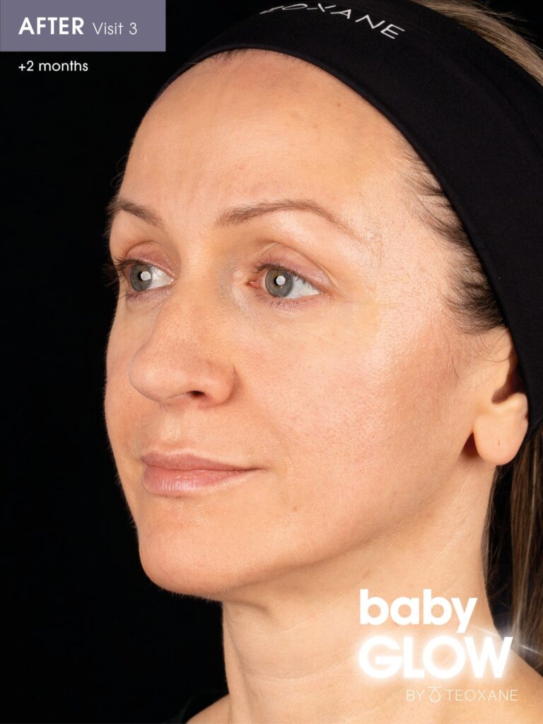 Two months after the third Teoxane babyGLOW session: Alena's skin looks firmer, smoother and more radiant.