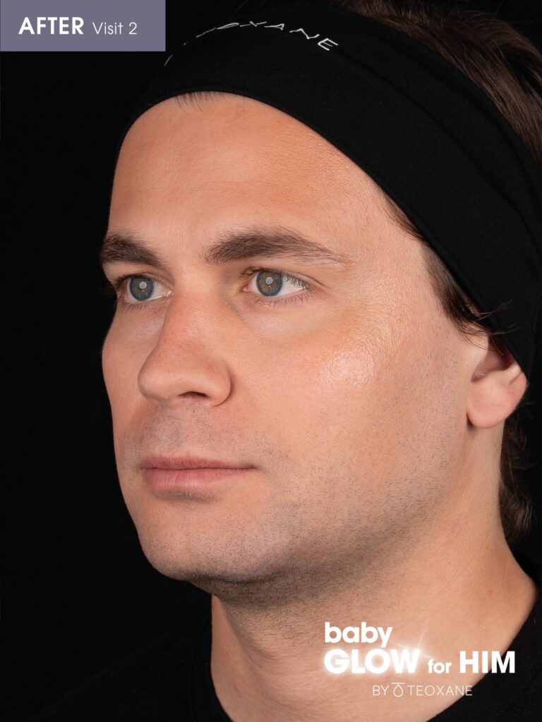 After the second Teoxane babyGLOW for HIM session: the 32 year old's skin looks brighter and more hydrated.