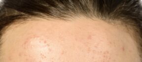 Blackheads and closed comedones across the skin
