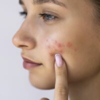 Red, inflamed spots on the cheek