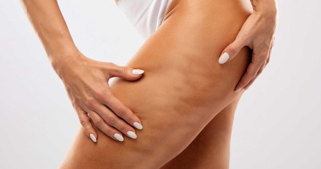 Cellulite