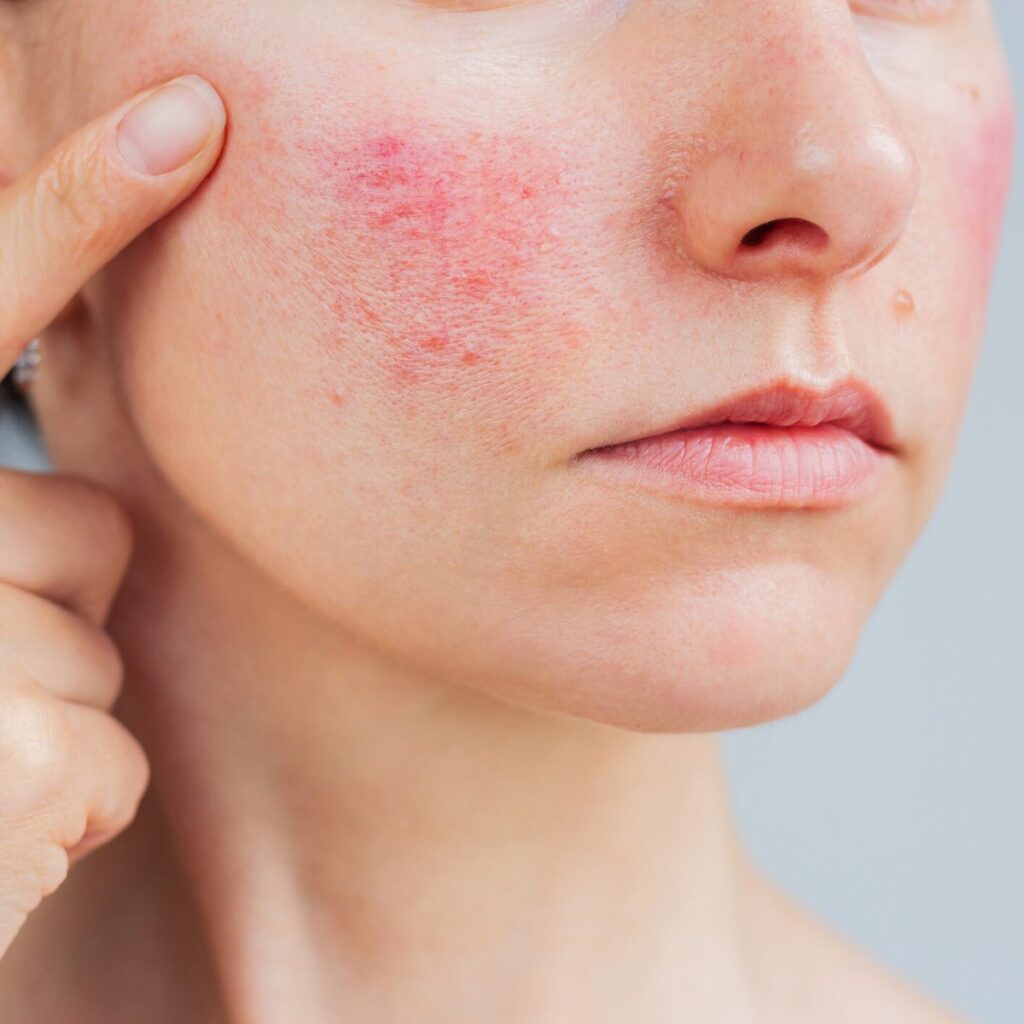 Rosacea & Facial Redness