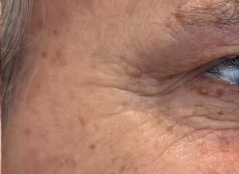 The same area after treatment, the pigment spots lighter