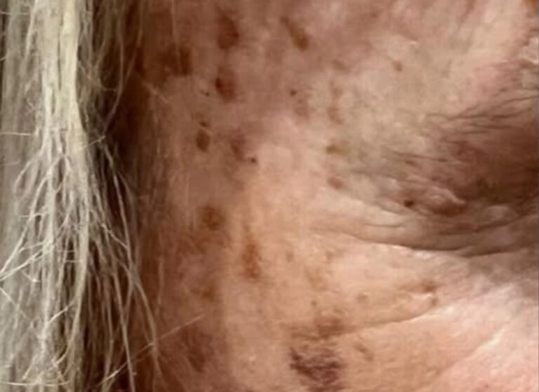 Cheek and eye area with brown pigment spots before treatment