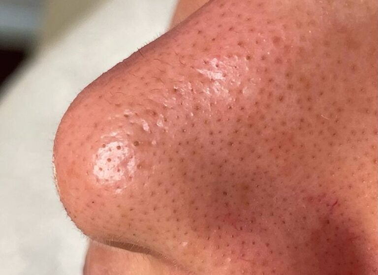 Side view of a nose before HydraFacial, with visible blackheads and open pores across the bridge and tip