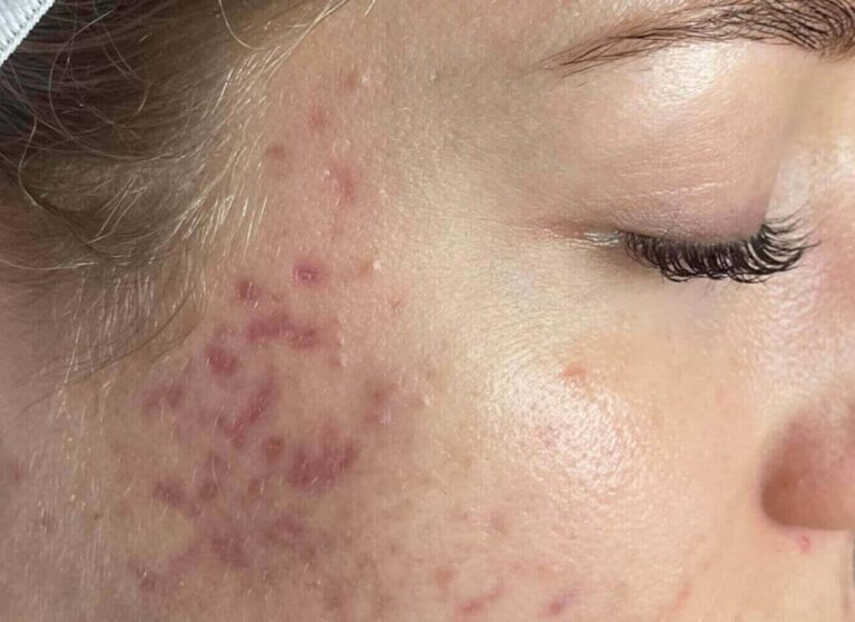 Cheek before SkinPen microneedling, with active breakouts and red post-inflammatory marks