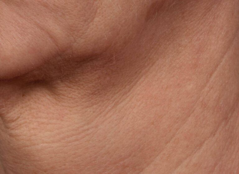Neck before SkinPen microneedling, with horizontal creping across the front