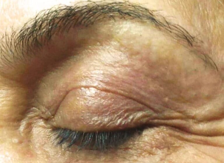 The same eye after plasma treatment, the upper eyelid skin tighter and smoother