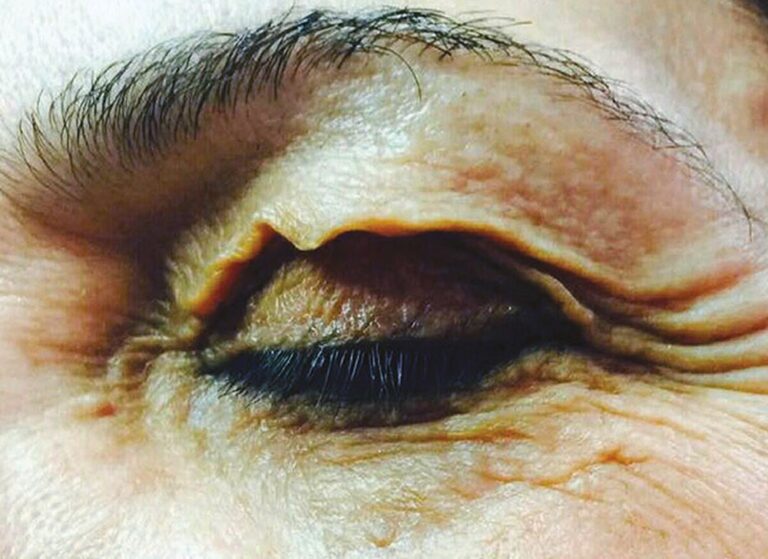 Closed eye before plasma treatment, with loose, crepey upper eyelid skin