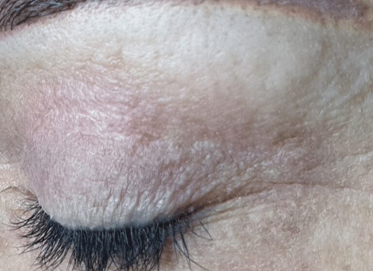 The same eye after plasma treatment, the eyelid skin tighter and smoother