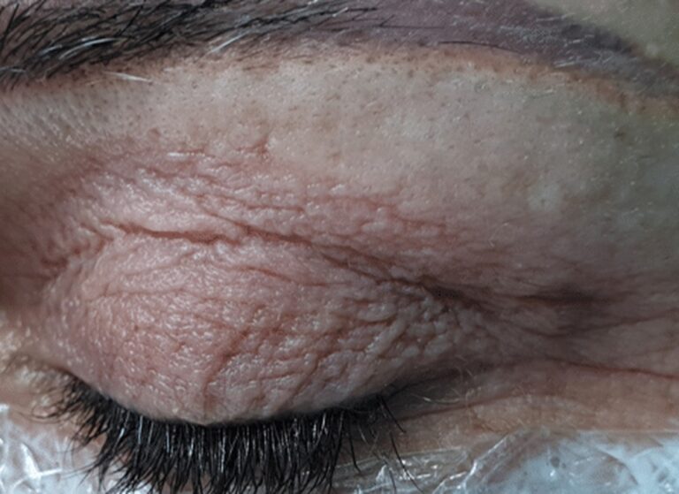 Closed eye before plasma treatment, with loose, wrinkled upper eyelid skin