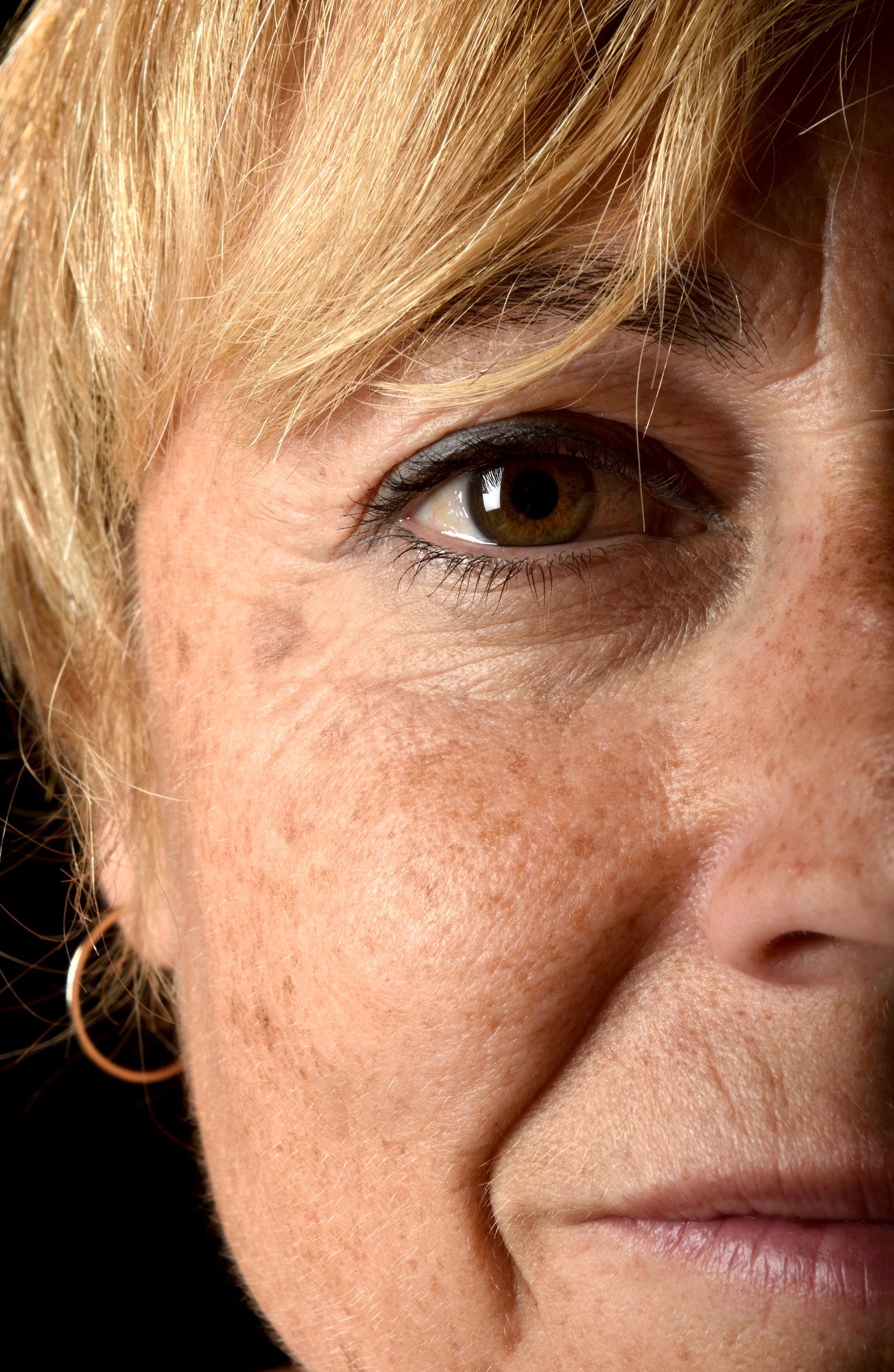Sun-induced age spots scattered across the cheek and temple