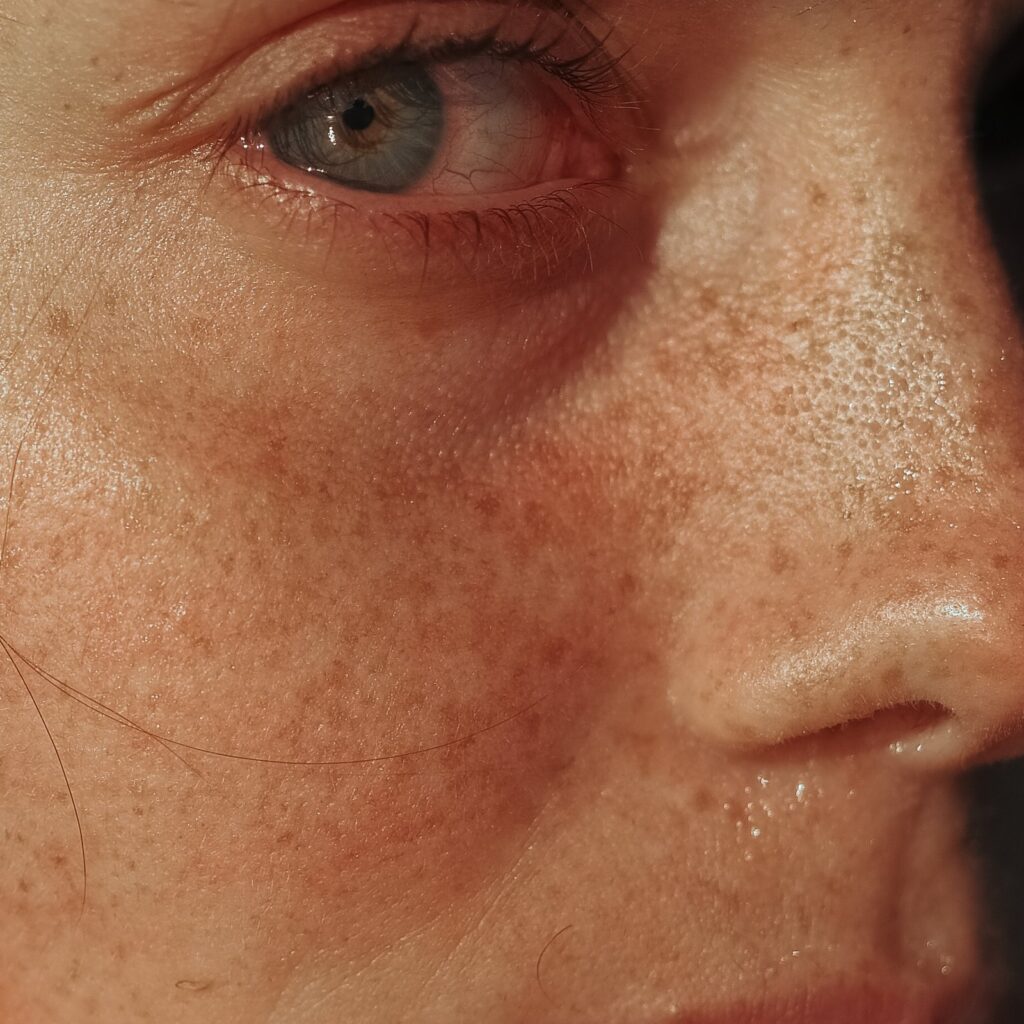Diffuse sun damage
