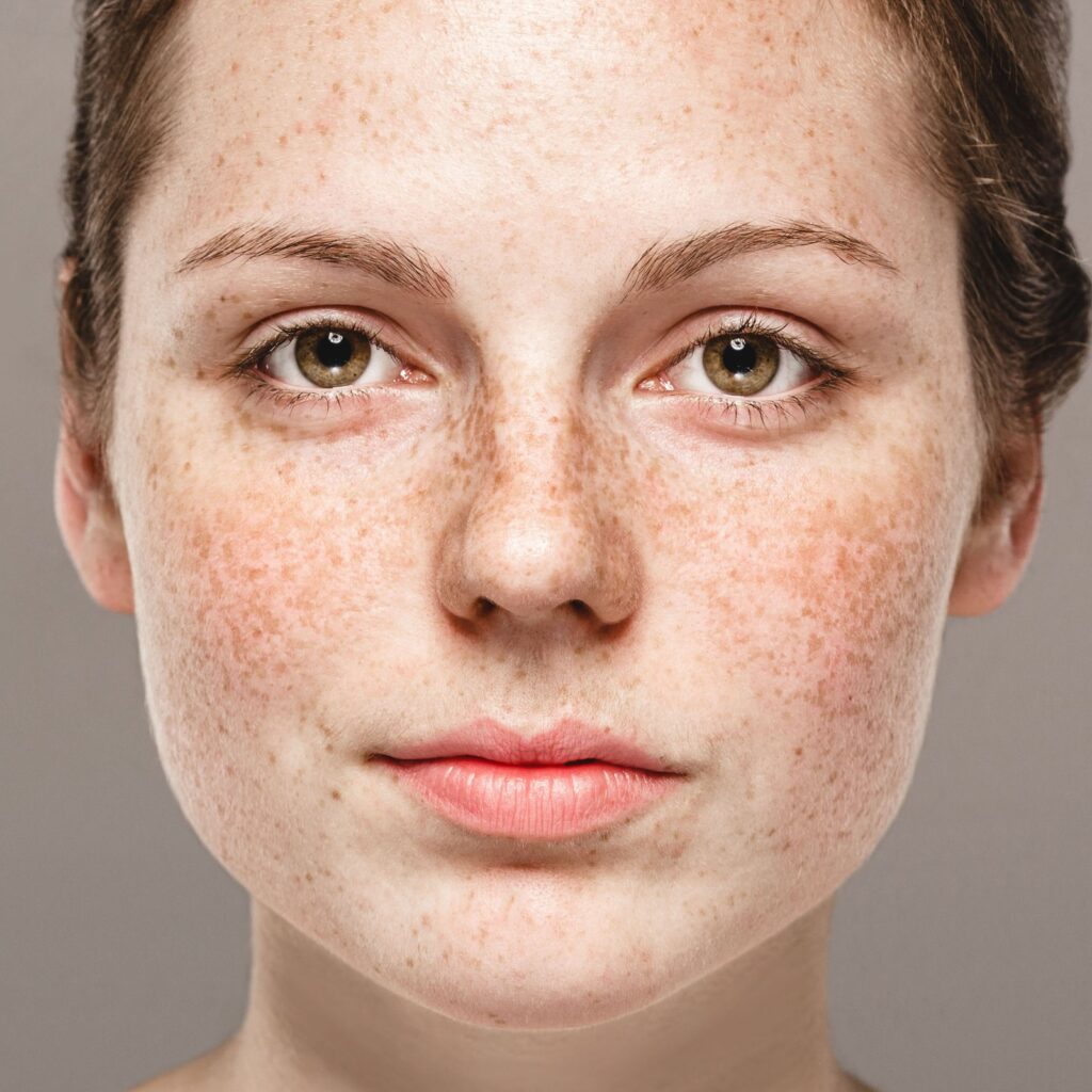 Freckles