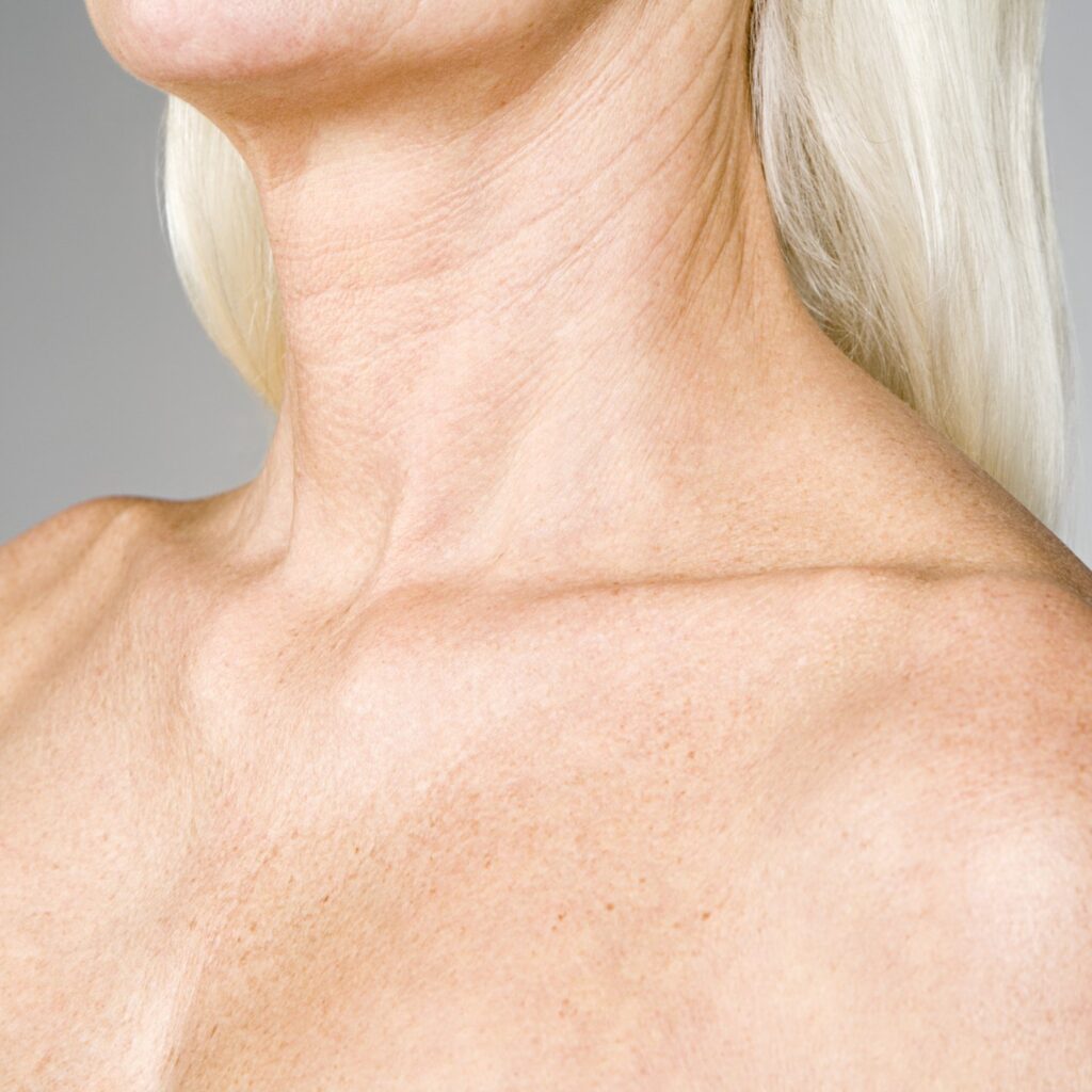 Actinic keratoses