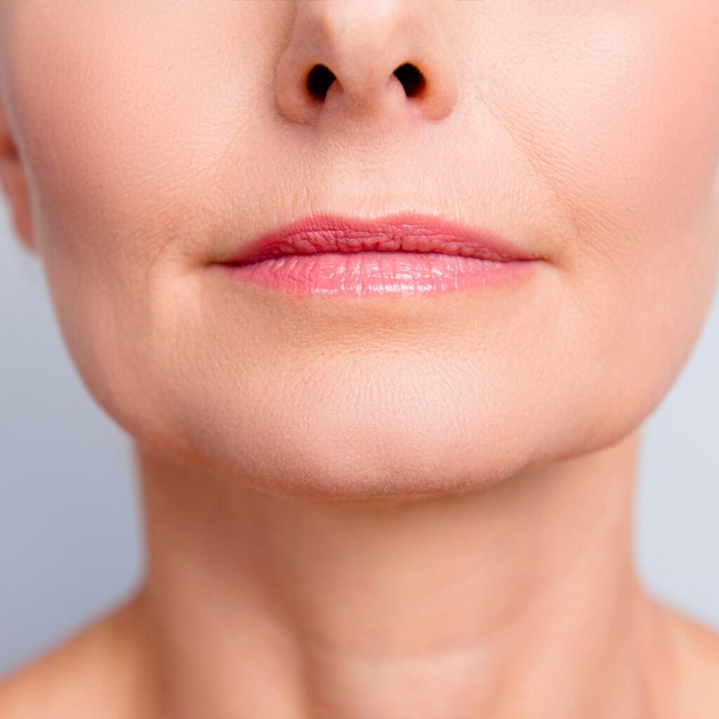 Lines with lip volume loss