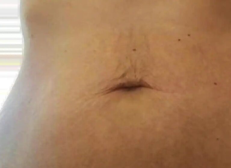 The same abdomen after a course of microneedling, the marks flatter and less visible against the surrounding skin