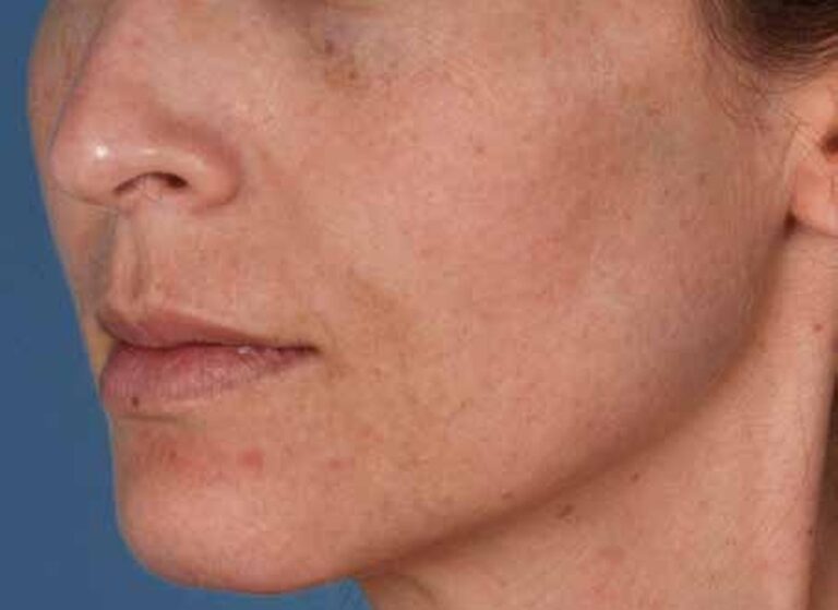 Face with dullness, lines and sun damage before a ZO programme