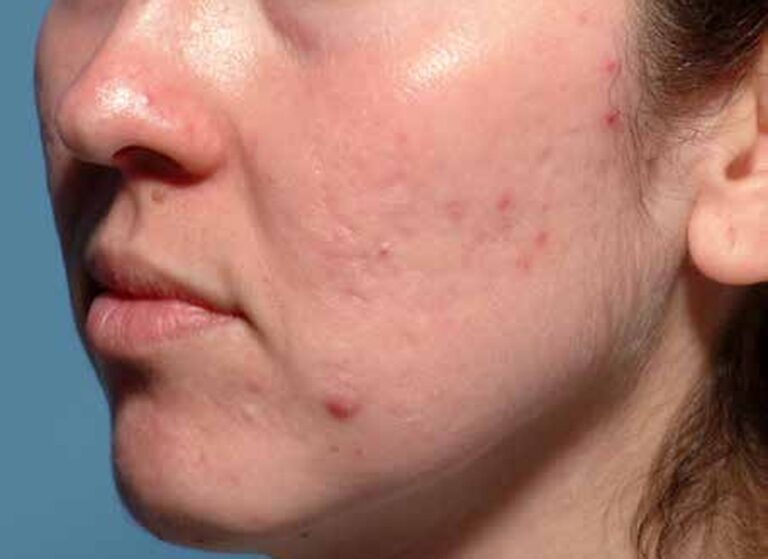 Cheek with active acne and marks before treatment