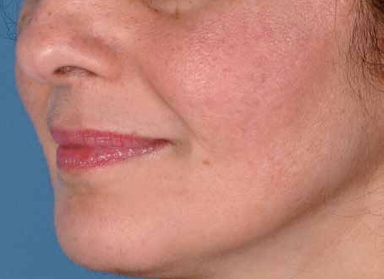 The same cheek after six months, with much less redness