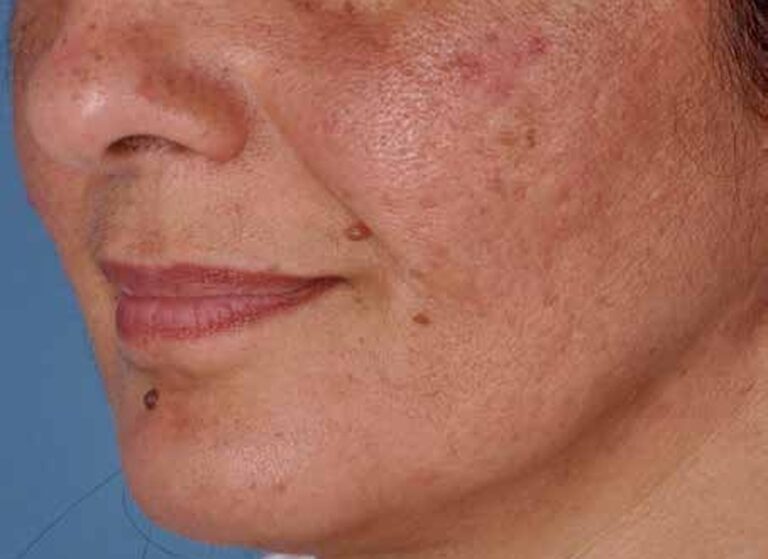Cheek with rosacea redness before a ZO programme