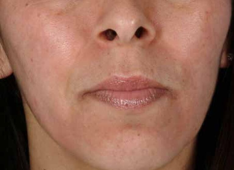 The same cheek after seven months, the freckles and spots much lighter