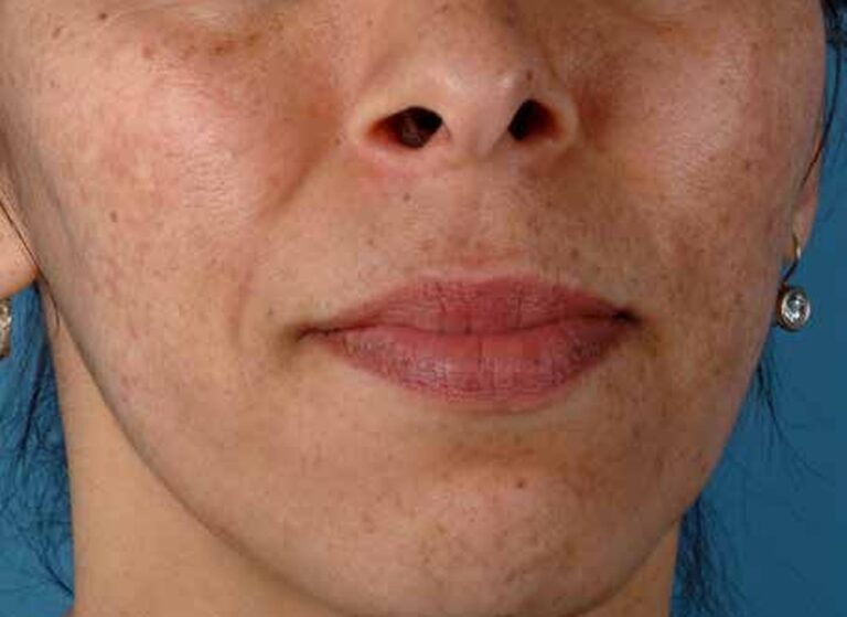Cheek with freckles and sun spots before a ZO programme