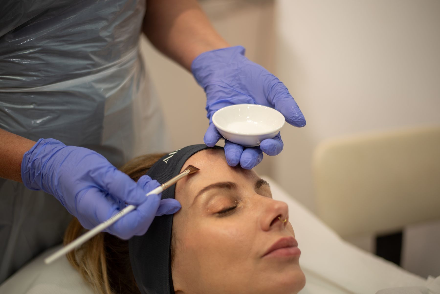 Chemical peel brushed across the forehead at Regents Park Aesthetics