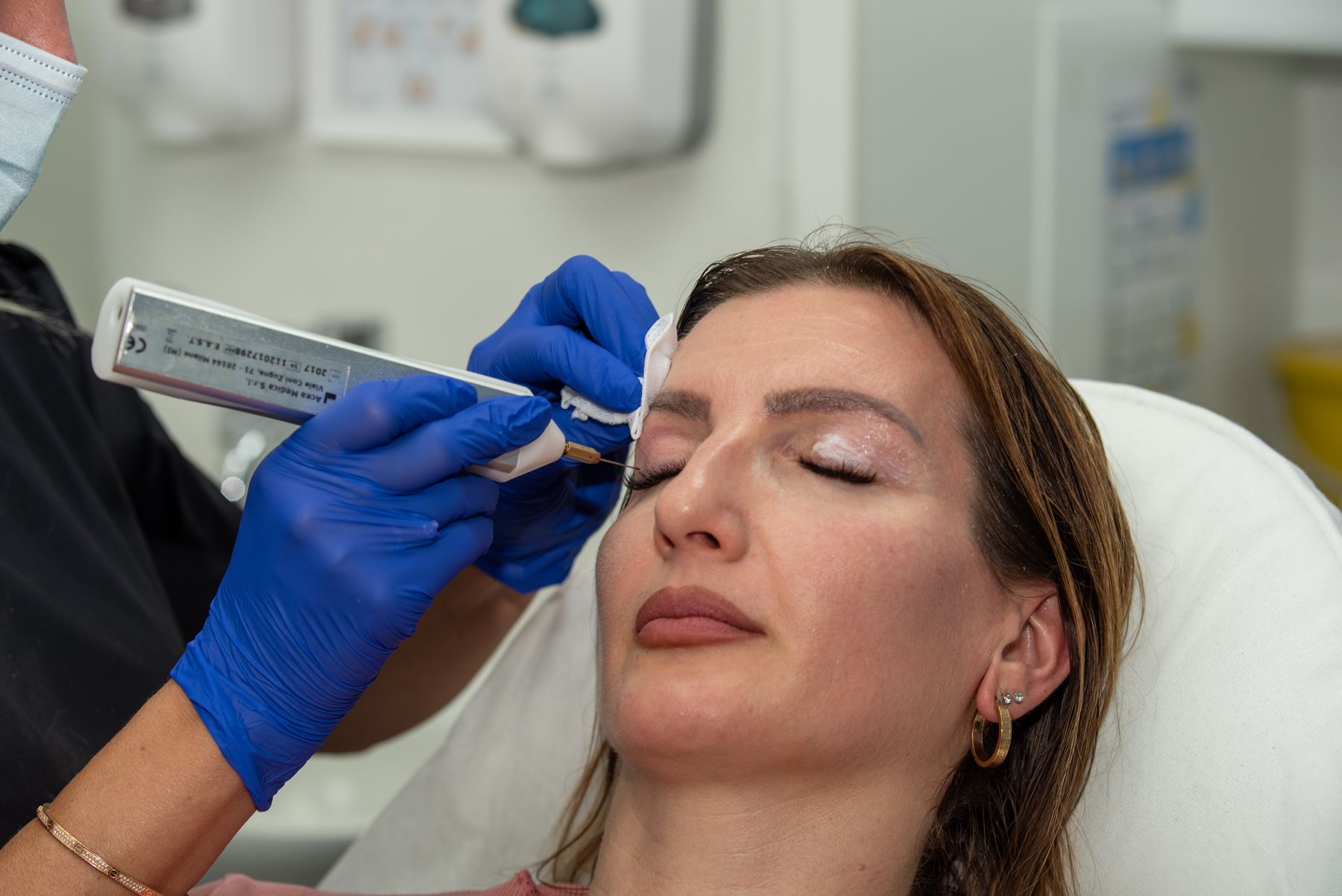 Plasma device treating the upper eyelid at Regents Park Aesthetics