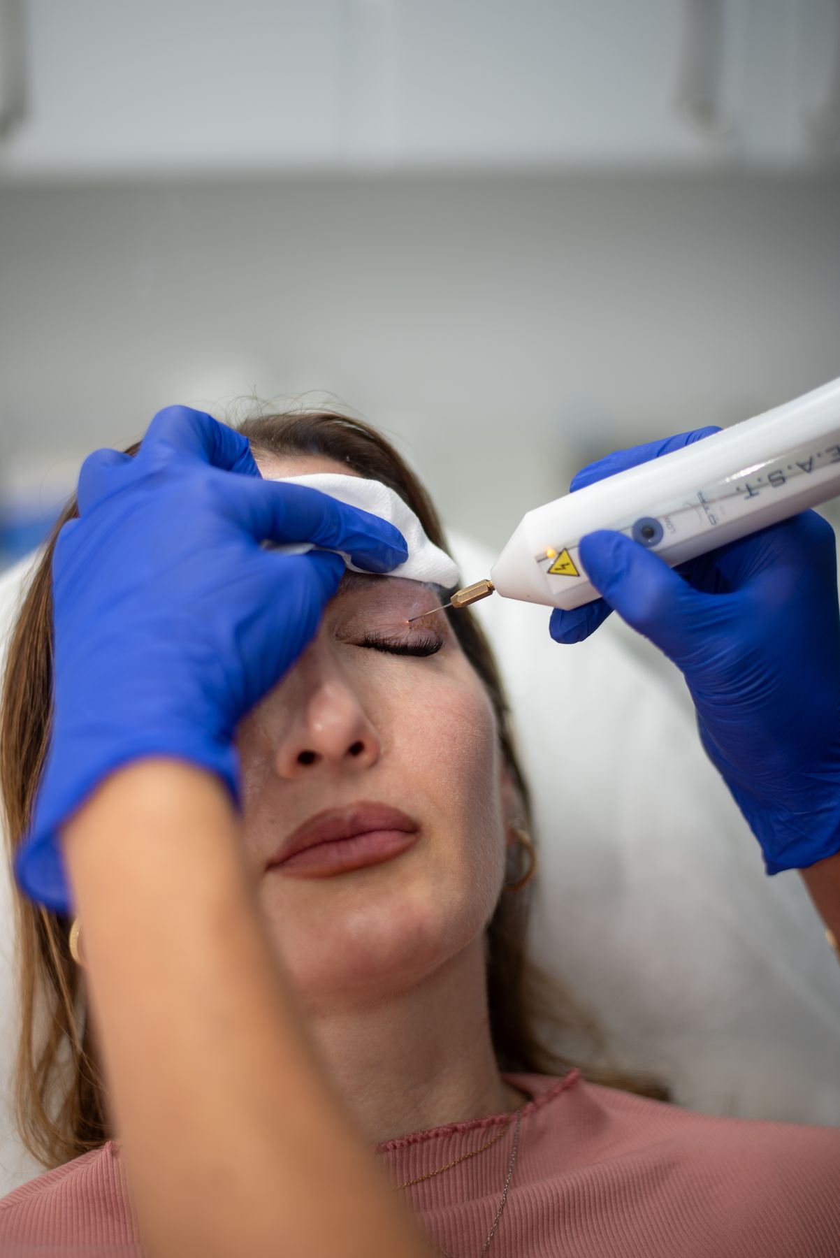 Close view of a plasma eyelid treatment at Regents Park Aesthetics