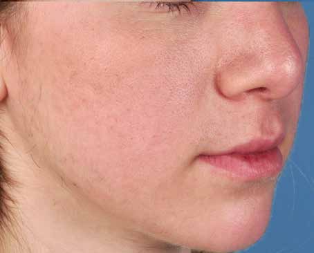 After ZO Skin Health treatment: acne. Clinical photograph by Zein Obagi, MD