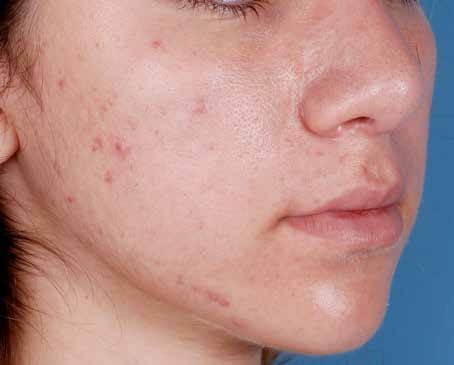 Before ZO Skin Health treatment: acne. Clinical photograph by Zein Obagi, MD