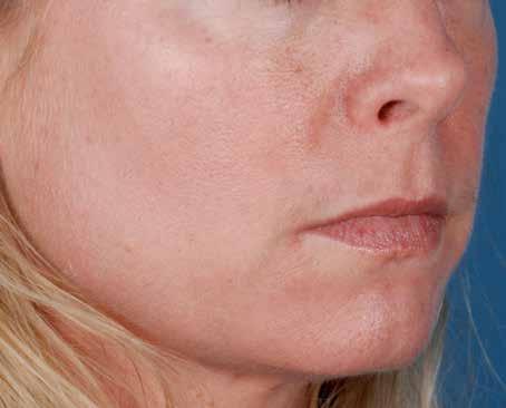 After ZO Skin Health treatment: early ageing. Clinical photograph by Zein Obagi, MD