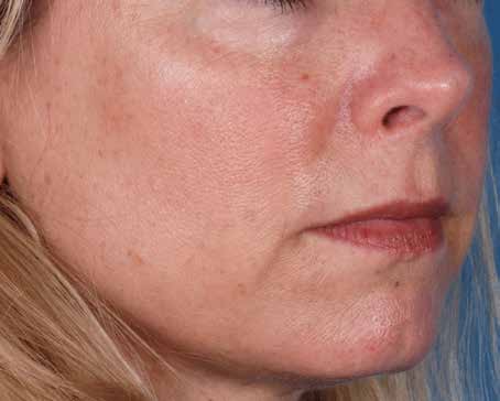 Before ZO Skin Health treatment: early ageing. Clinical photograph by Zein Obagi, MD