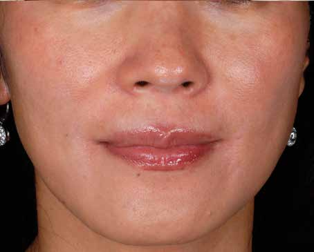After ZO Skin Health treatment: pigmentation. Clinical photograph by Zein Obagi, MD