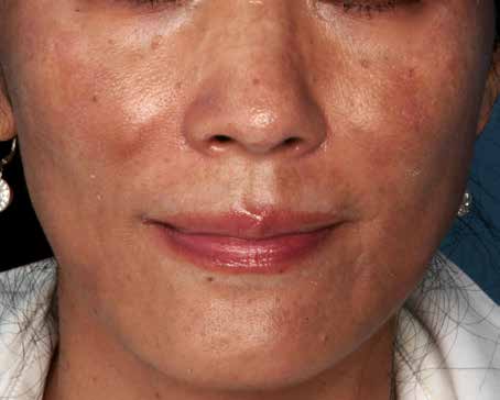 Before ZO Skin Health treatment: pigmentation. Clinical photograph by Zein Obagi, MD