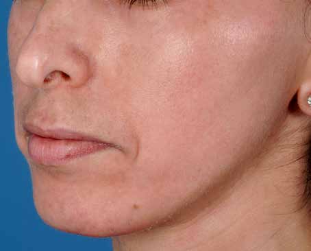 After ZO Skin Health treatment: melasma. Clinical photograph by Zein Obagi, MD
