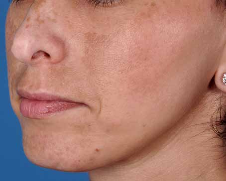 Before ZO Skin Health treatment: melasma. Clinical photograph by Zein Obagi, MD