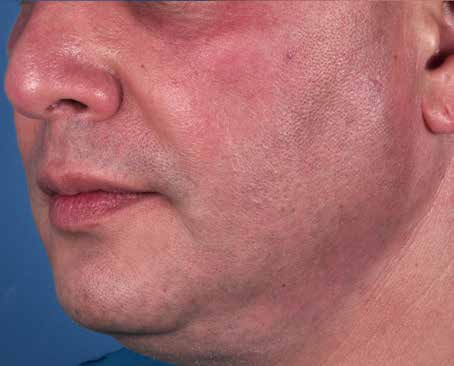 After ZO Skin Health treatment: oily skin and large pores. Clinical photograph by Zein Obagi, MD
