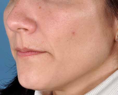 After ZO Skin Health treatment: rosacea. Clinical photograph by Zein Obagi, MD