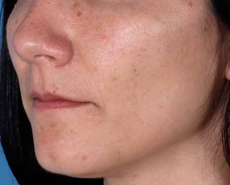 Before ZO Skin Health treatment: rosacea. Clinical photograph by Zein Obagi, MD