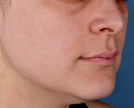After ZO Skin Health treatment: sun damage. Clinical photograph by Zein Obagi, MD