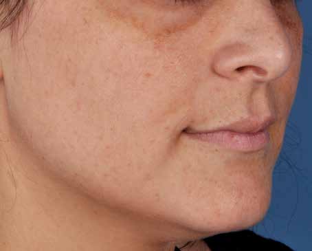 Before ZO Skin Health treatment: sun damage. Clinical photograph by Zein Obagi, MD