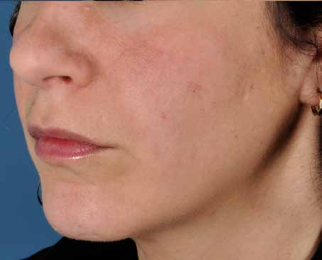 After ZO Skin Health treatment: sun damage and pigmentation. Clinical photograph by Zein Obagi, MD