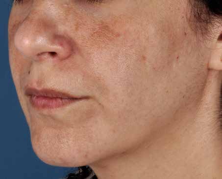 Before ZO Skin Health treatment: sun damage and pigmentation. Clinical photograph by Zein Obagi, MD