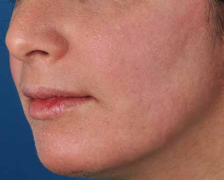 After ZO Skin Health treatment: texture. Clinical photograph by Zein Obagi, MD