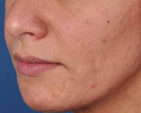 Before ZO Skin Health treatment: texture. Clinical photograph by Zein Obagi, MD