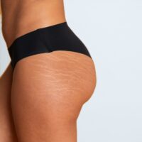 Older stretch marks faded to white or silver